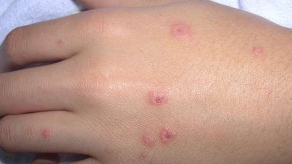 Полиморфная аллергия что это такое thumbnail