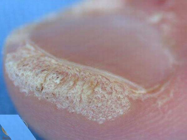 Под ногтем большого пальца ноги нарост кожи