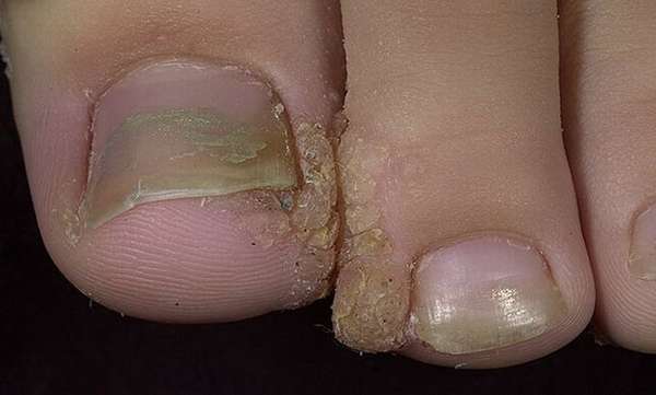 Нарост кожи на пальце ноги возле ногтя