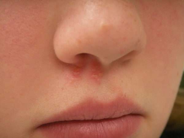 Герпес в носовых пазухах симптомы