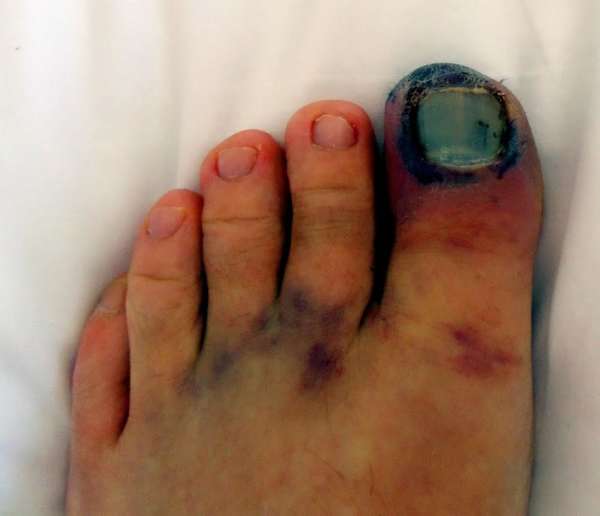 Гематома под ногтем большого пальца ноги без травмы