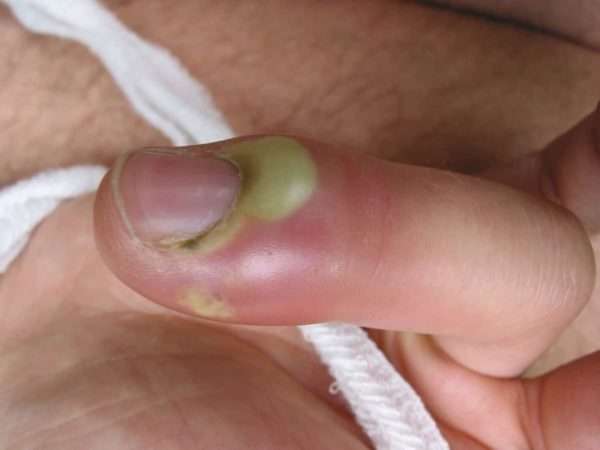 Воспаление заусенца на ногтей