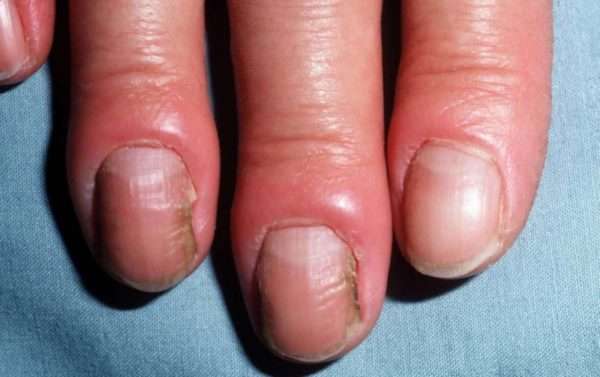 Панариций пальца лечение мкб 10