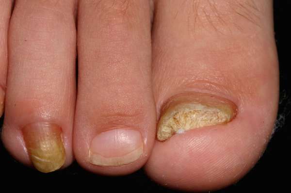 Под ногтем большого пальца ноги нарост кожи