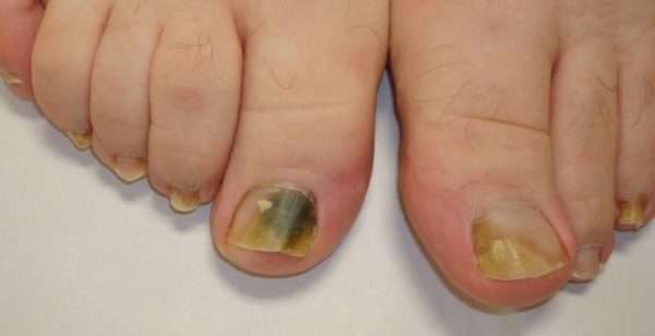 Черное пятно под ногтем на большом пальце ноги болит