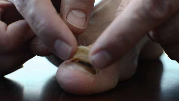 Гематома ногтя большого пальца ноги