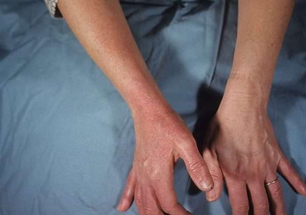 Лечение рожистого воспаления кожи руки