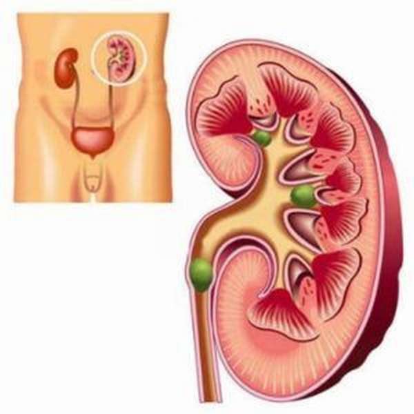 Микролиты в почках что. Заболевания мочевыделительной системы мочекаменная болезнь.